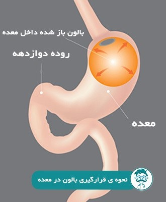 آیا بای‌پس معده عوارض دارد+چه آمپولی برای لاغری خوب است+آیا بالون معده عوارض دارد+نظرات درباره بالون معده