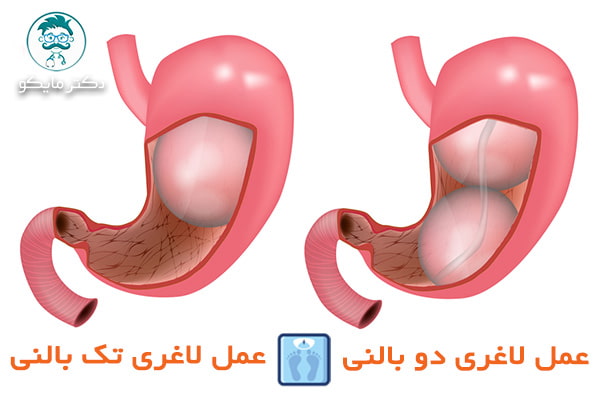 مراقبت های پس از عمل بالن معده