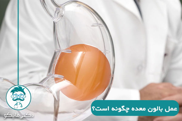 عمل بالون معده چیست؟