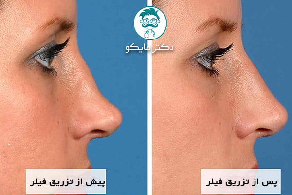 قبل و بعد از تزریق فیلر بینی