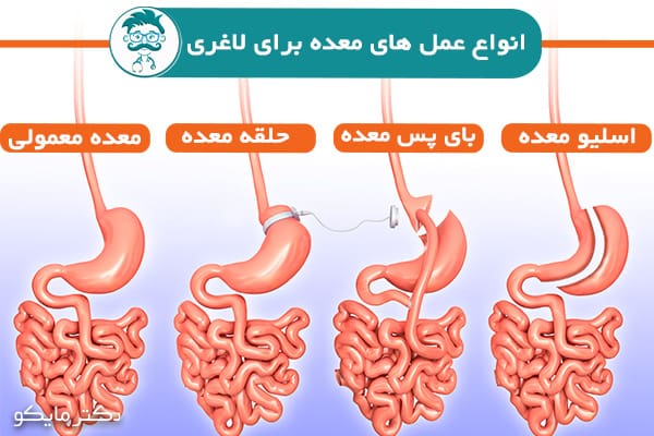 انواع عمل های لاغری