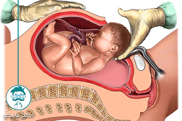 مراحل زایمان سزارین