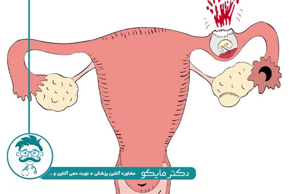 سقط جنین بر اثر حاملگی خارج از رحم