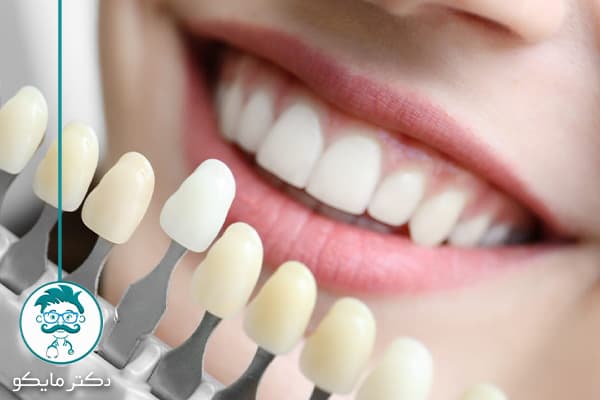 انواع لمینت دندان
