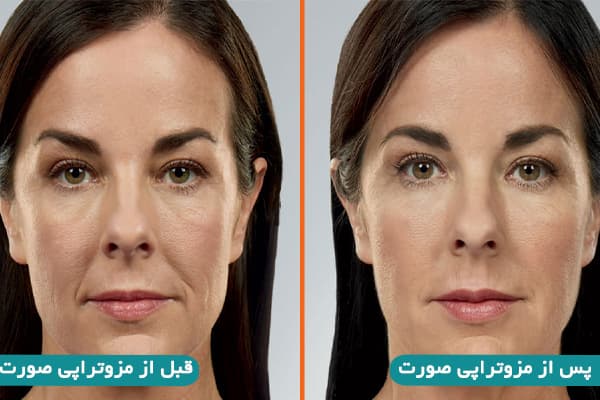 عکس قبل و بعد مزوتراپی صورت
