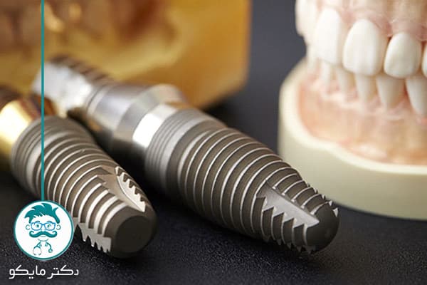 قیمت ایمپلنت فوری