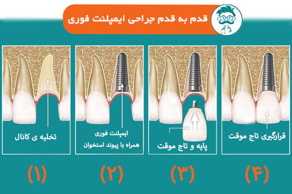 مراحل جراحی ایمپلنت فوری