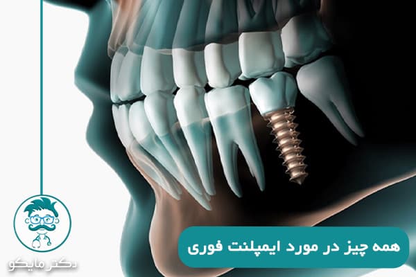 ایمپلنت فوری یک روزه