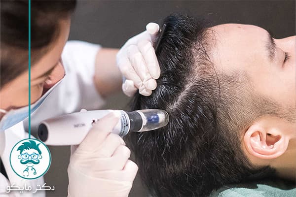 عوارض مزوتراپی مو