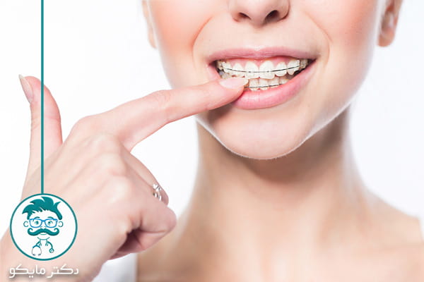 ریتینر (نگهدارنده) ارتودنسی دندان