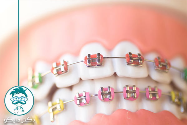ارتودنسی دندان رنگی