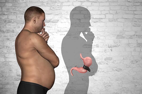 صفر تا صد عمل حلقه معده: راهی برای لاغری راحت