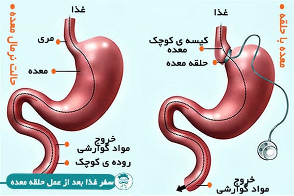 حلقه معده