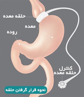 عمل حلقه انداختن معده چگونه انجام می شود؟

