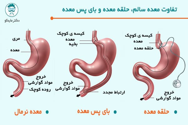 باندینگ معده بهتر است یا بای پس معده؟