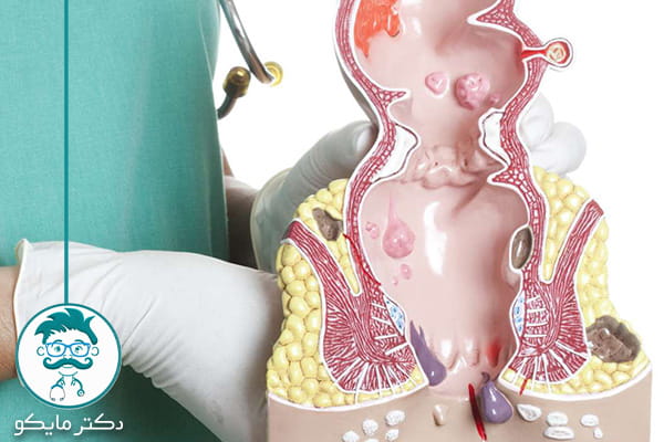 بیماری بواسیر در کودکان