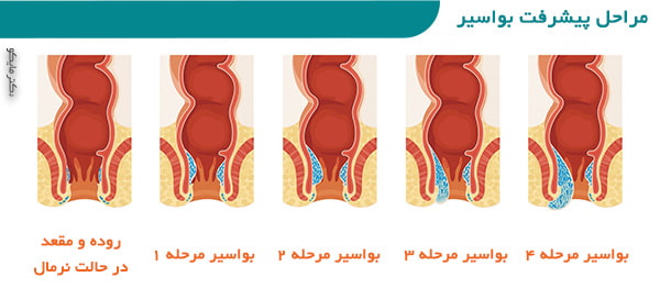 مراحل پیشرفت بواسیر 