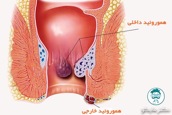 هموروئید داخلی و خارجی 