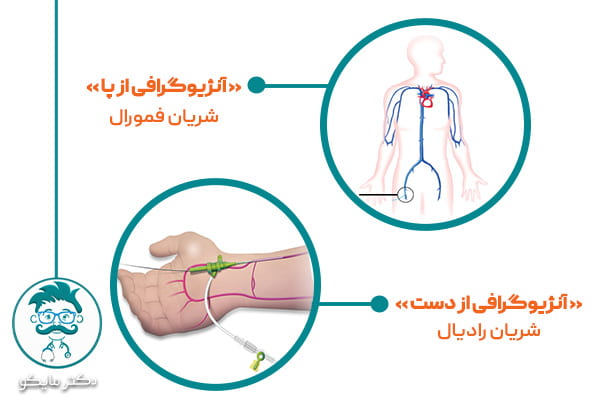 آنژیوگرافی قلب از پا و دست چگونه انجام می شود؟