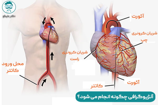 مراقبت های بعد از آنژیوگرافی قلب