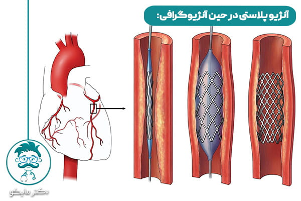 آنژیوی قلب چقدر طول می کشد؟