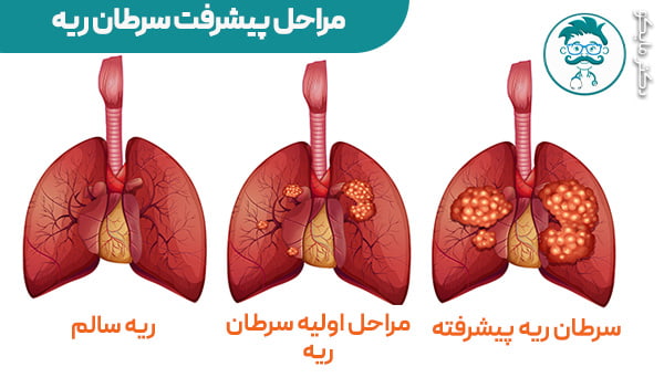 پیشرفت سرطان ریه 