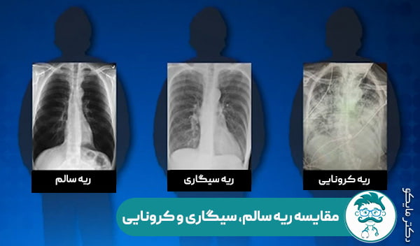 ریه کرونایی و سیگاری