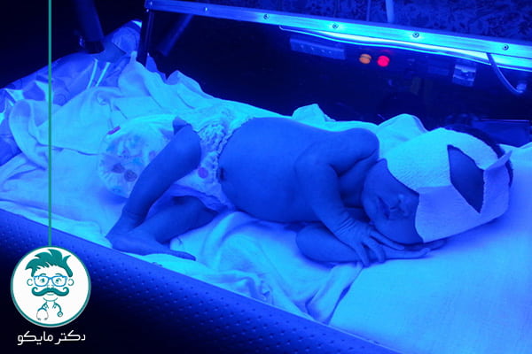 سریع‌ترین و بهترین راه‌های درمان زردی نوزاد