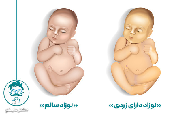درجه زردی نوزادان باید چند باشد؟