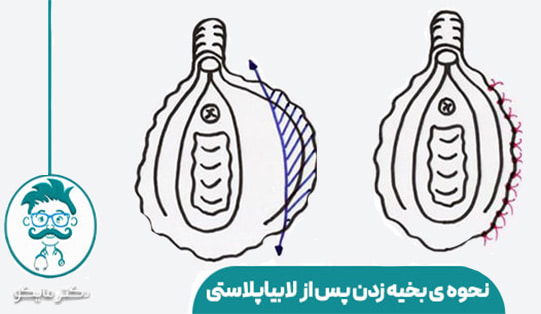 نحوه ی بخیه زدن بعد از لابیاپلاستی
