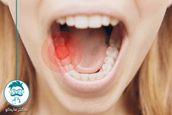 زردچوبه برای عفونت دندان