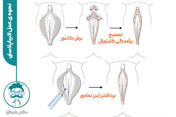 سؤالات پرتکرار در مورد عمل لابیاپلاستی