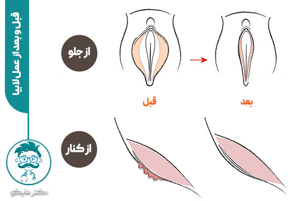 قبل و بعد از لابیاپلاستی