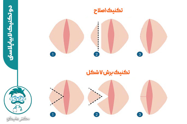 عمل-لابیاپلاستی-4.jpg