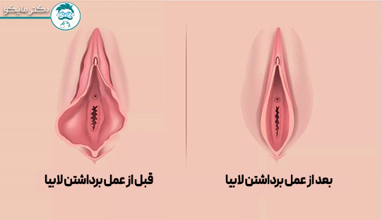 قبل و بعد از برداشتن لابیا
