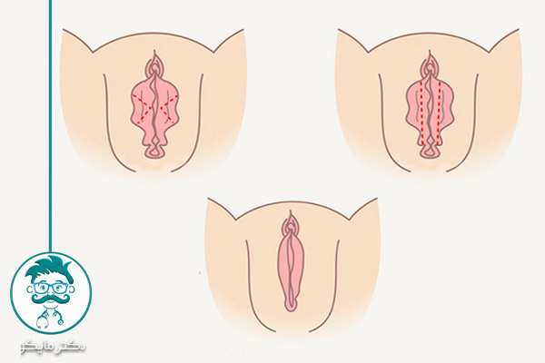 هزینه لابیا پلاستی با لیزر