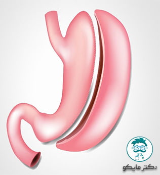 جراحی لاغری اسلیو