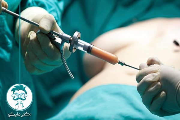 عمل لیپوساکشن