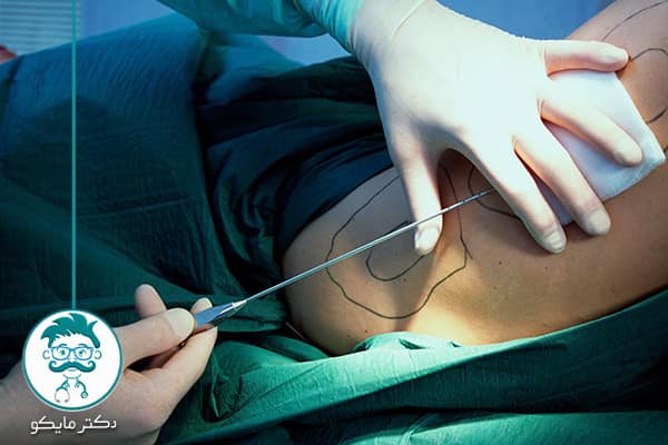 جراحی لاغری لیپوماتیک