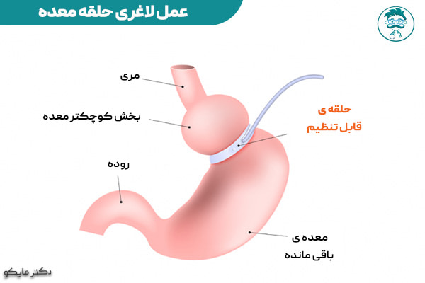 عمل لاغری حلقه یا باندینگ معده