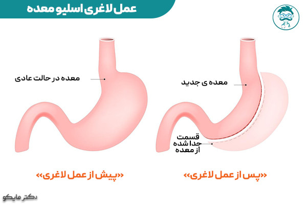 عمل لاغری اسلیو