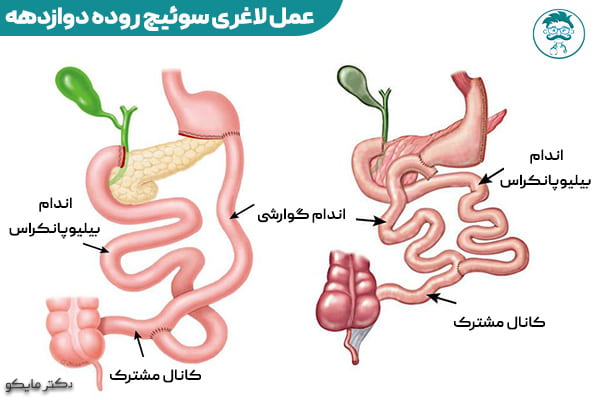 عمل لاغری سوئیچ روده دوازدهه