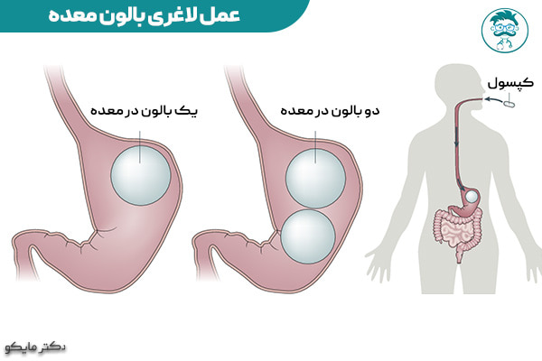 عمل لاغری بالن معده