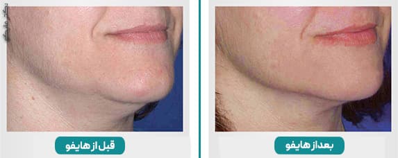 قبل و بعد از هایفوی غبغب