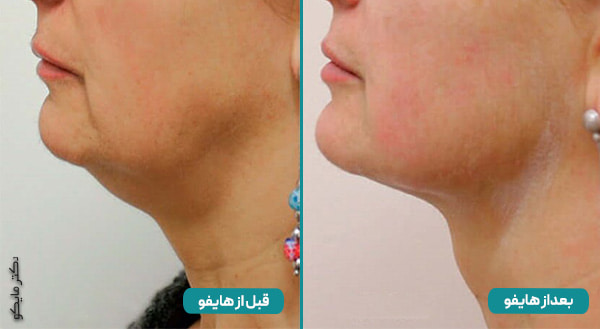 هایفوتراپی غبغب