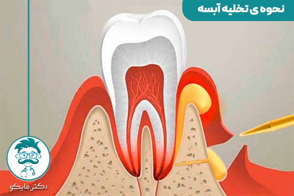 تخلیه آبسه دندان