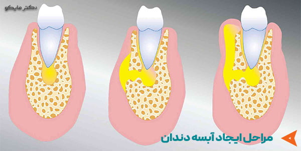  روش های پیشگیری از آبسه دندان