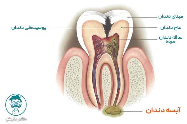 چرا آبسه دندان اتفاق می افتد؟