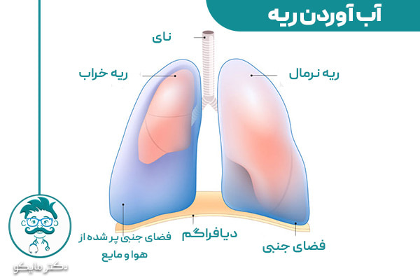 منظور از آب آوردن ریه