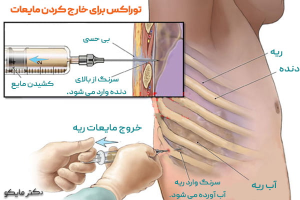 خارج کردن مایعات ریه از طریق توراکس